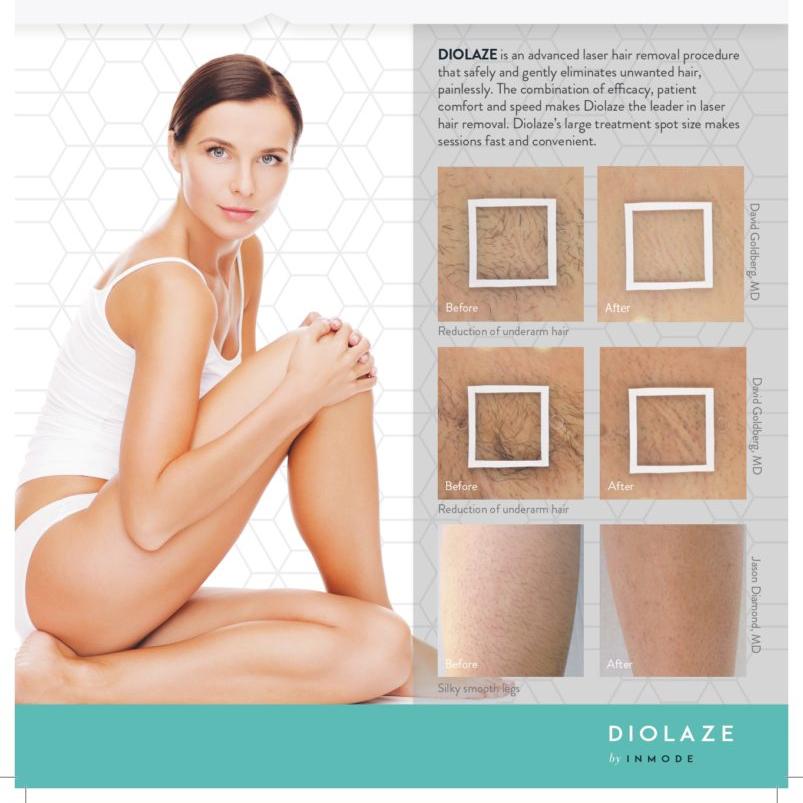 Diolaze Laser Hair Removal - Brazilian - Series of 6 Treatments