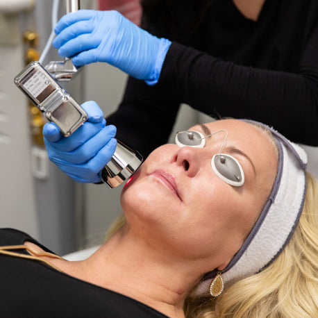 MICROLASER PEEL Face & Neck